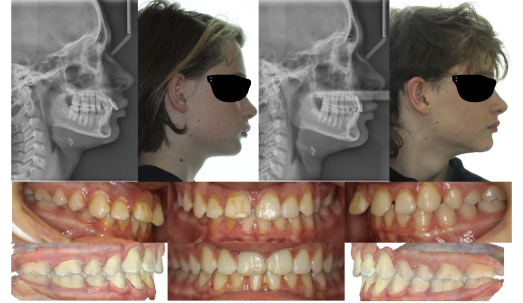 Traumatized Anteriors & Overjet